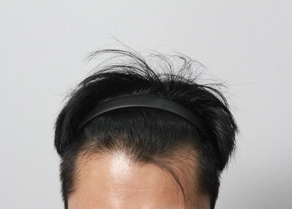 Moat hair transplant D+1 20220922