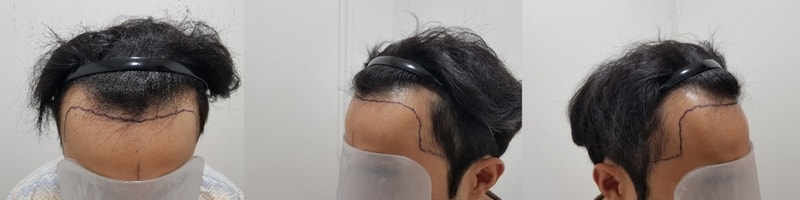 수술전.jpg