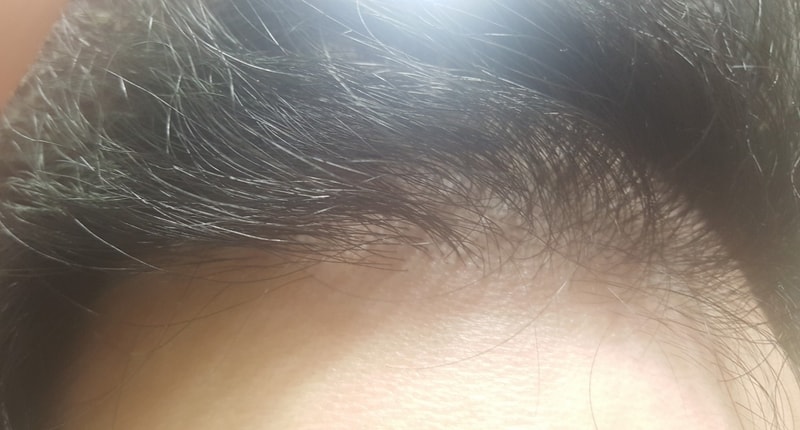 It's the 8th month review of the hair follicle