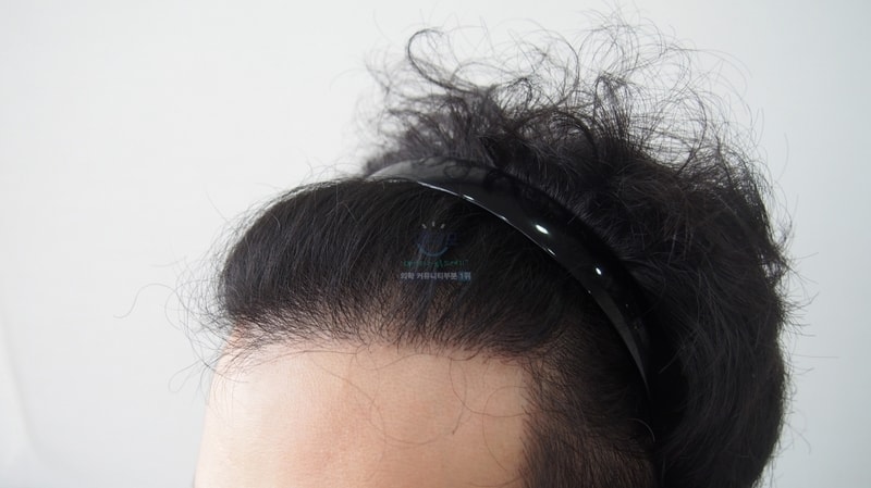 I'm posting it as a comparative picture of the 4,100-mo incision surgery in the first year of the parent company
