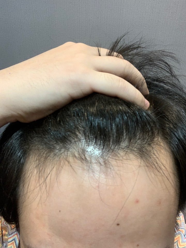 Apgujeong Mobiang incisional hair transplantation in Gwangju, late 19th day