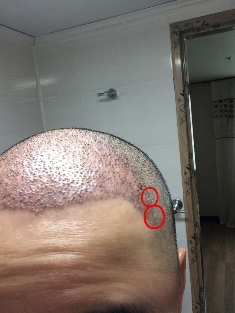 밖모낭02.jpg