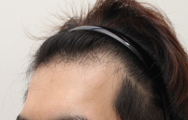 I had an M-shaped hair loss incision last week