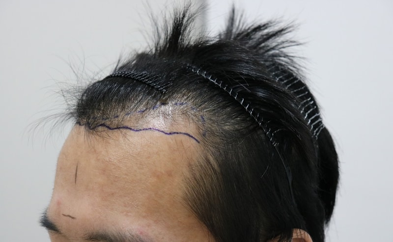 수술전2.jpg