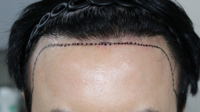 수술 전, 65일 째 기록용으로 남깁니다.