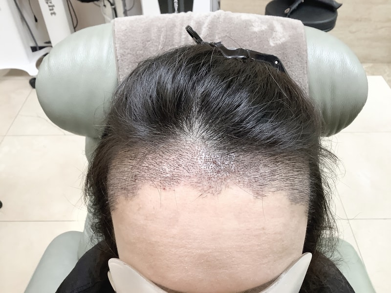 [Growing up] It's the 13th day of non-cut hair transplantation.