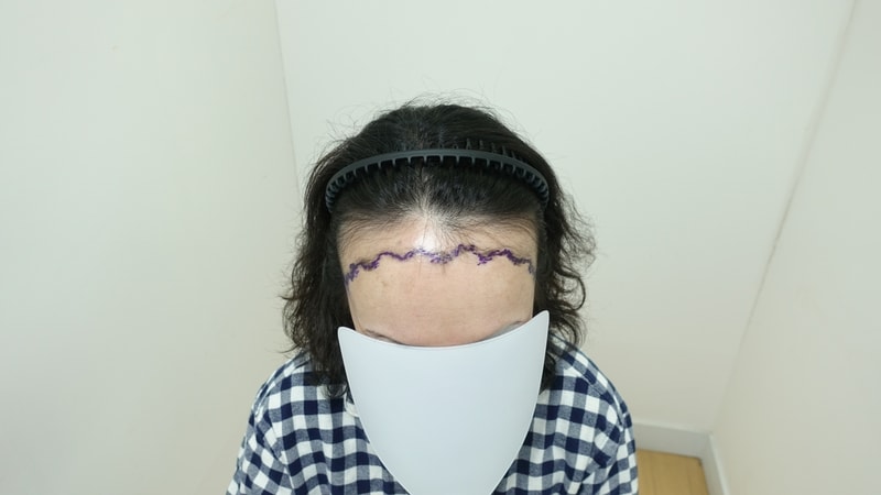 [Growing up] It's the first day of hair transplantation