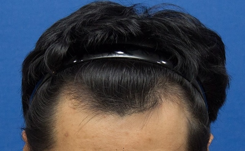 이식전.jpg