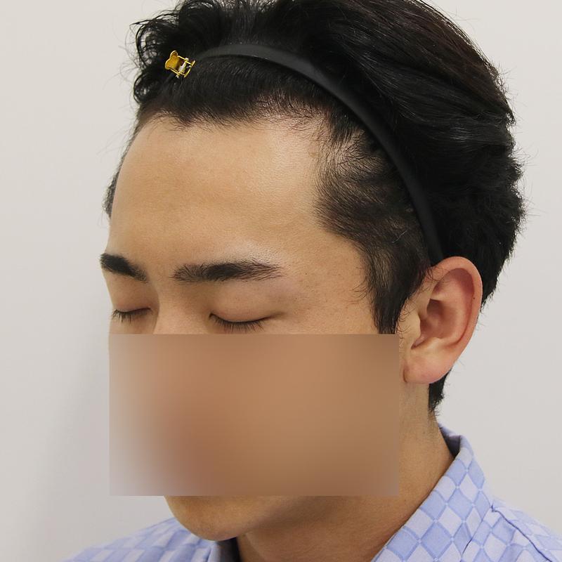 부산 엠자 모발이식 4개월 후기 공유합니다!!_맘모스헤어라인
