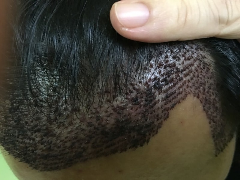 ヘアライン-こめかみ 1600 毛包 3ヶ月 暗黒期 ㅠㅠ기