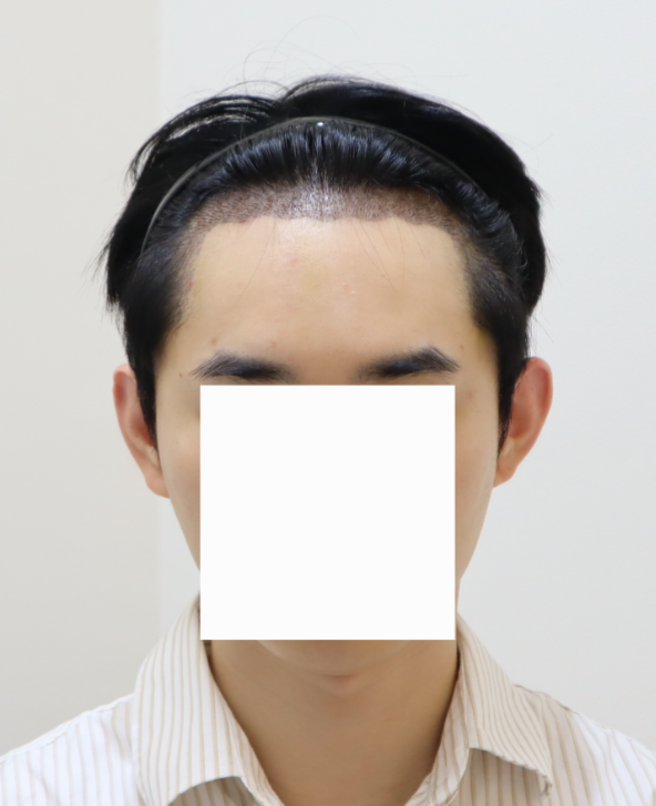 밴스모자이너 모발이식 2200모 10일차 후기