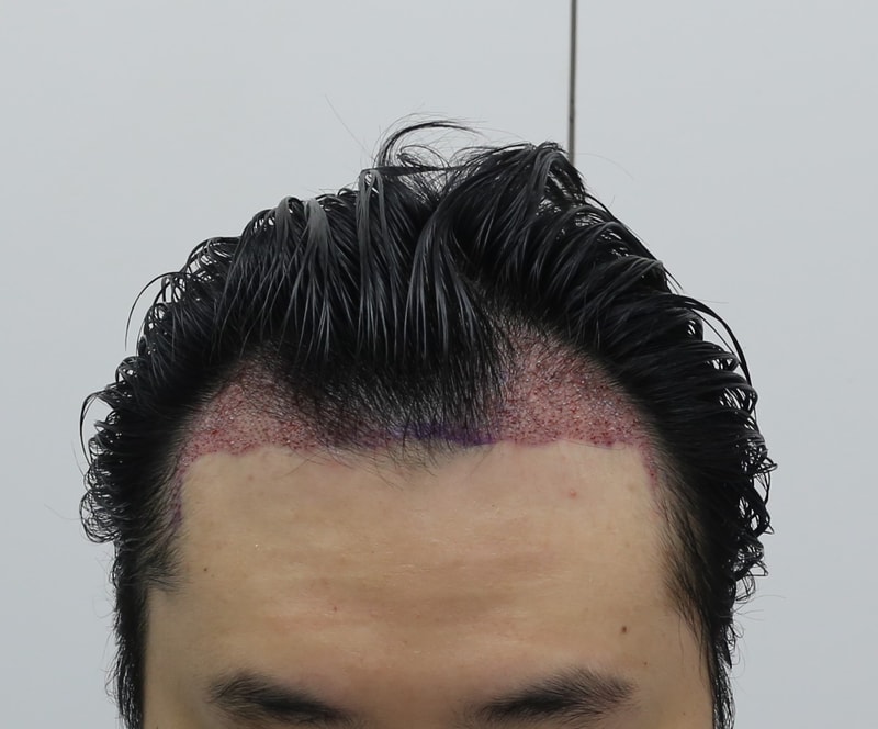 수술 후.jpg