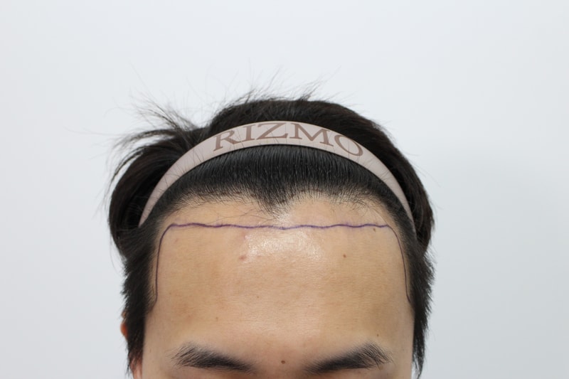 부산 리즈모의원 모발이식 2주차경과