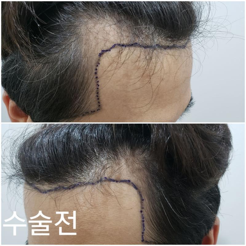 모바른 한상보 70일 경과