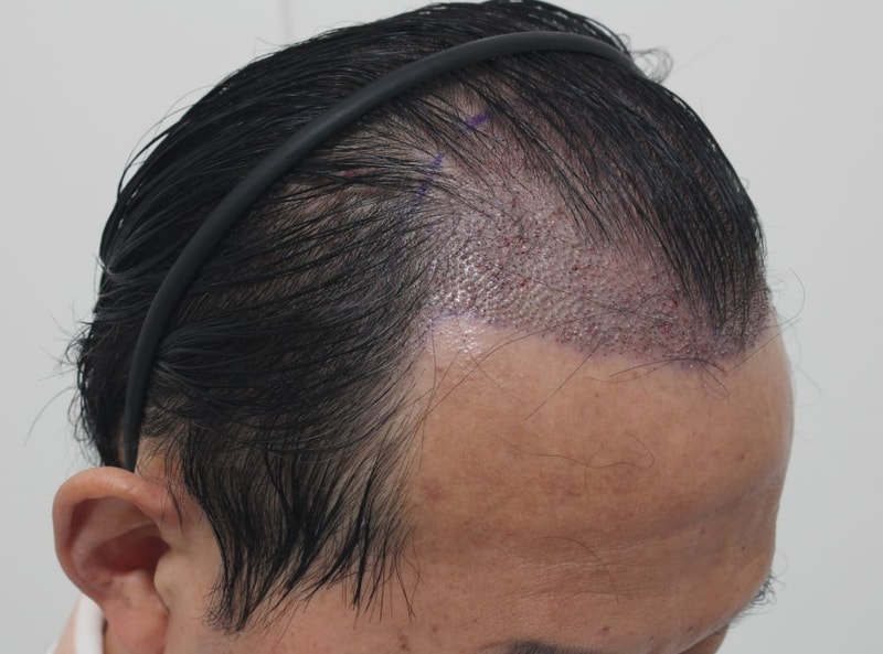 06.수술당일.JPG