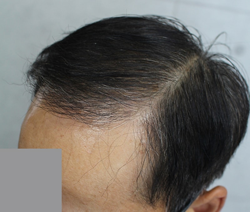 수술 휘 (2).JPG