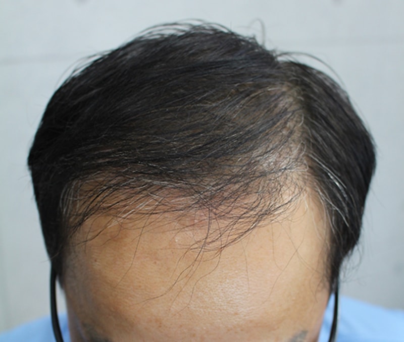 수술 휘 (1).JPG