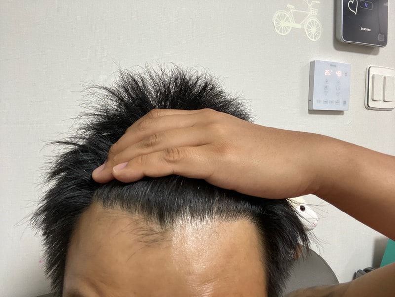 모스트 모발이식센터 2400모 비절개 이식 후기2
