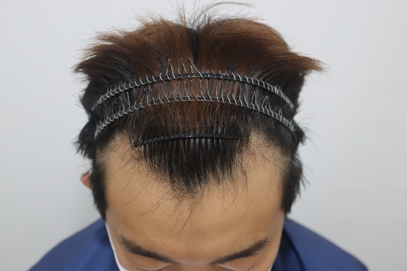 수술당일2.jpg