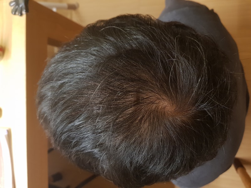 This is a picture of 8 months after the surgery. I'm satisfied!