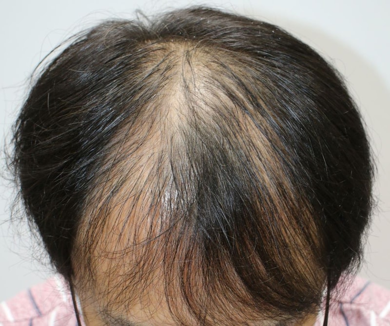 Daegu hair transplant forehair non-cut slit 4-month-old hair is getting fuller