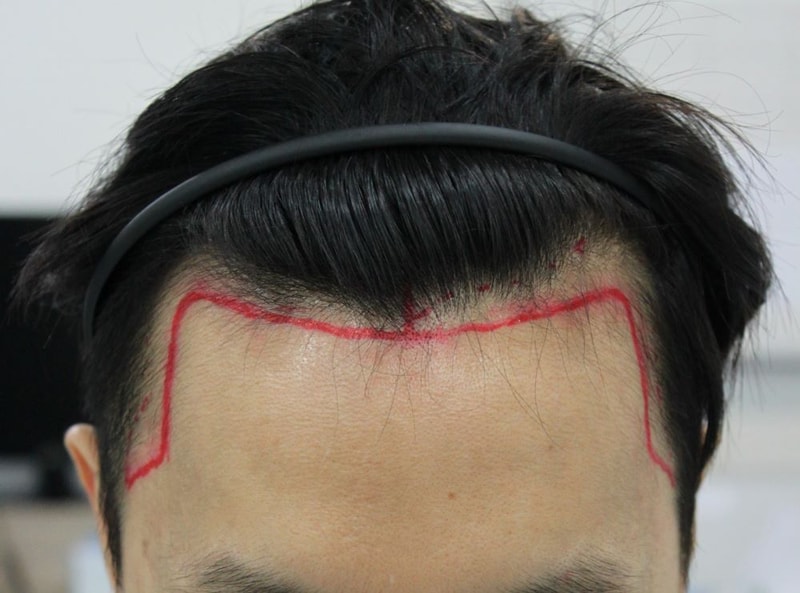 Busan Po Hair Non-Sectionless Haircut M-shape Hair Hair Loss Review for 4 Months