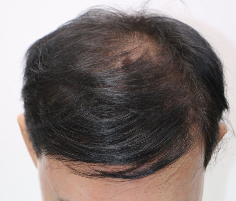 因对7年前手术不满意，在大邱FORHAIR进行了再手术。