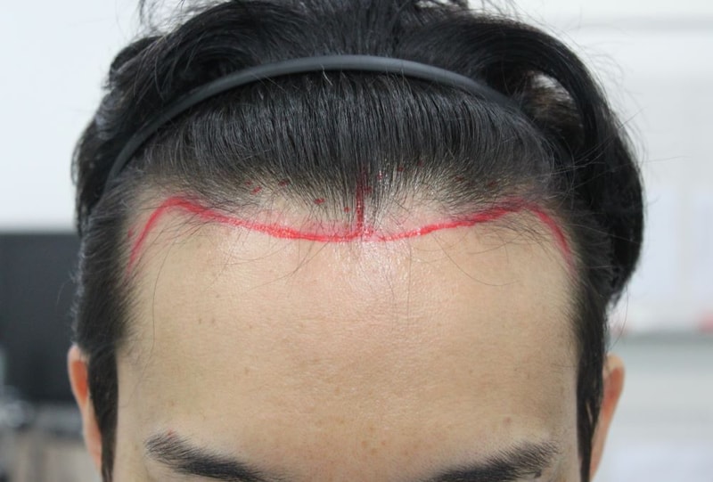 Busan Po Hair Non-Cutting Hair Transplantation M-shaped Hair Hair Loss in 5 Months