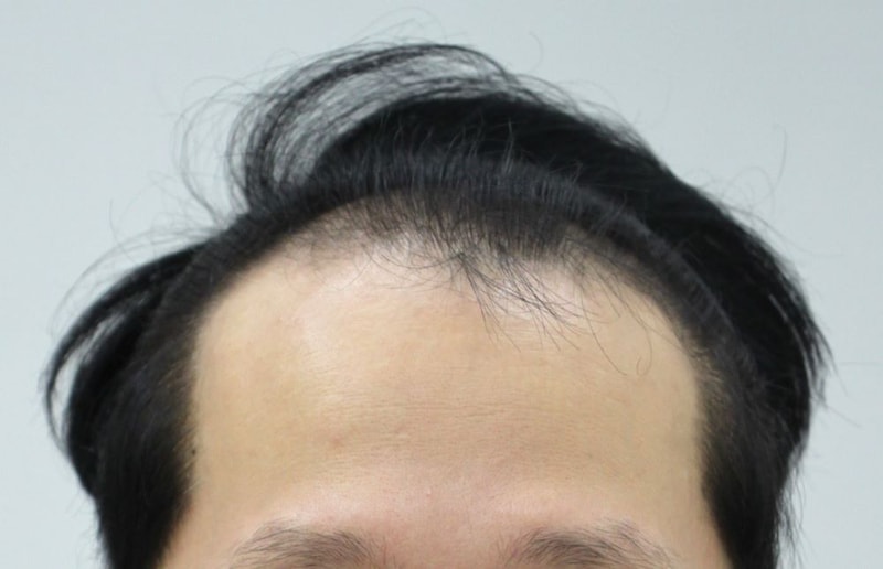 압구정 포헤어 민영기원장님 비절개모발이식 3주차 후기