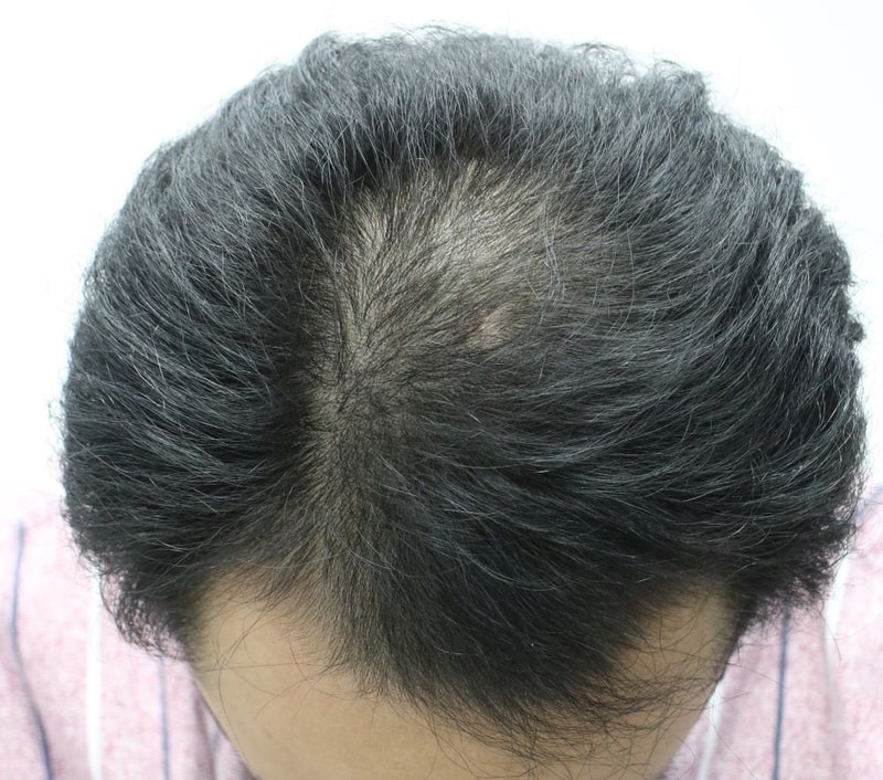 M-shape + tofu 2482 hair follicles for 1 month [Daegu For Hair Non-cut Slits]