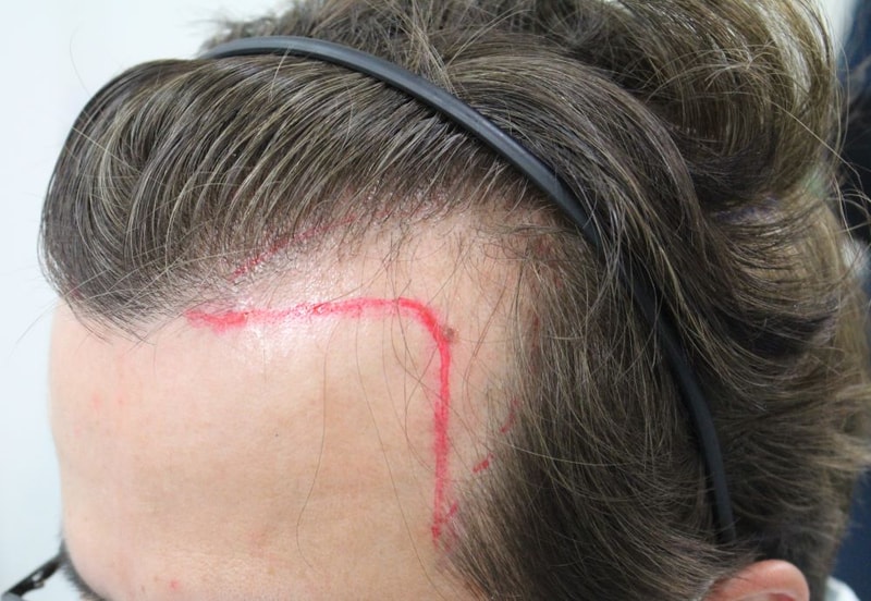 40s M-shaped hair Busan For Hair Non-Sectionless Hair 1 month review
