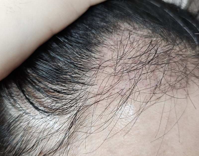 3. 수술후_3개월_셀카_3.jpg