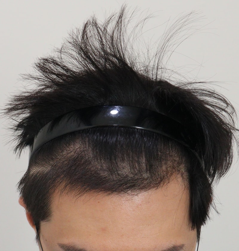 4. 수술후_5개월_2.JPG