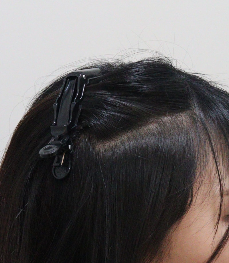 4. 수술후_6개월_1.JPG