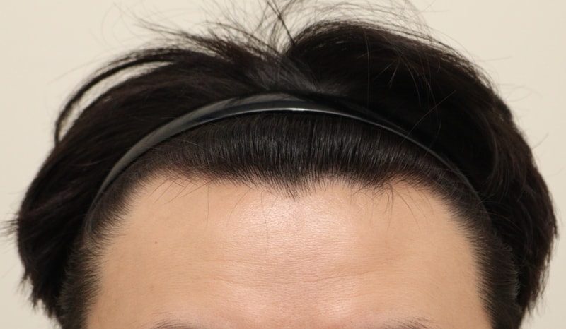 ヘアライン毛髪移植2週目です~！
