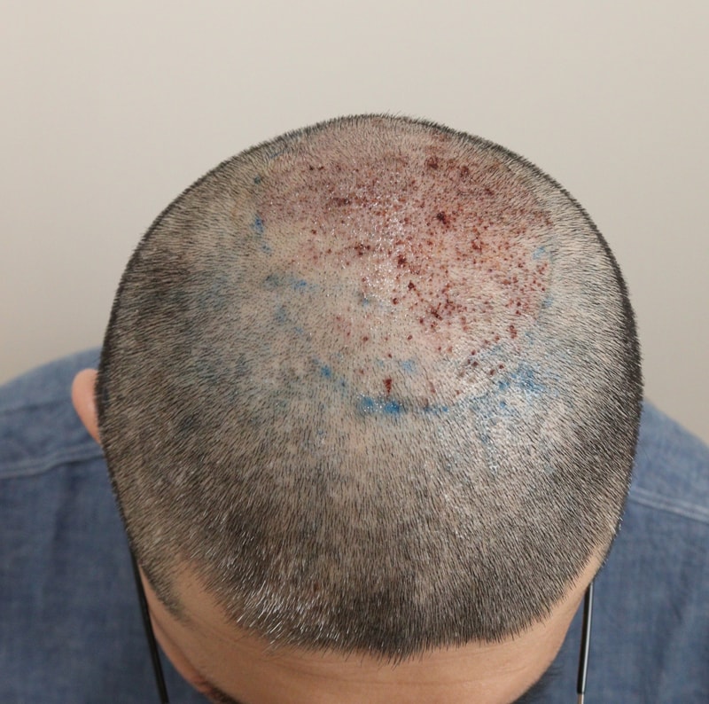 2. 수술후_1일.JPG