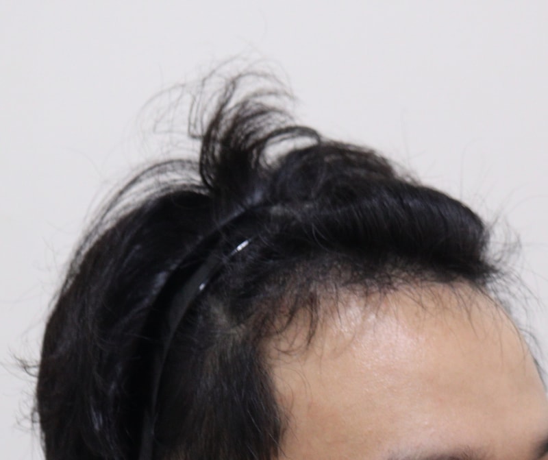 3. 수술후_6개월_3.JPG
