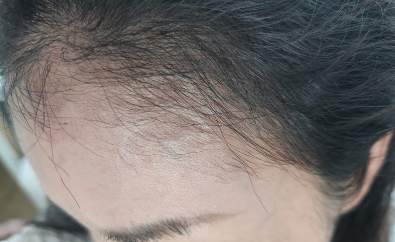 3. 수술후_3개월_셀카_2.jpg