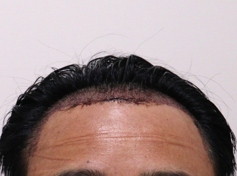 2. 수술후_1일_1.JPG
