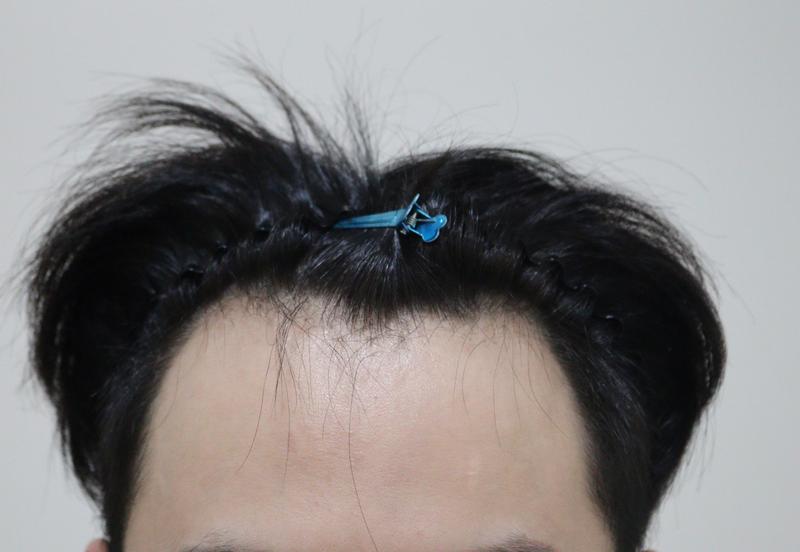 엠자 채우면서 자연스럽게 수술 완료