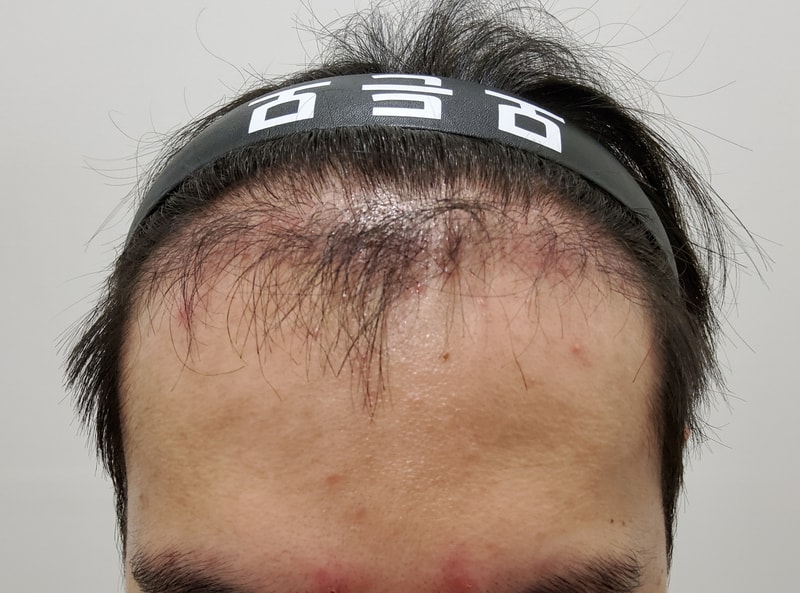 3. 수술후_3개월_1.jpg