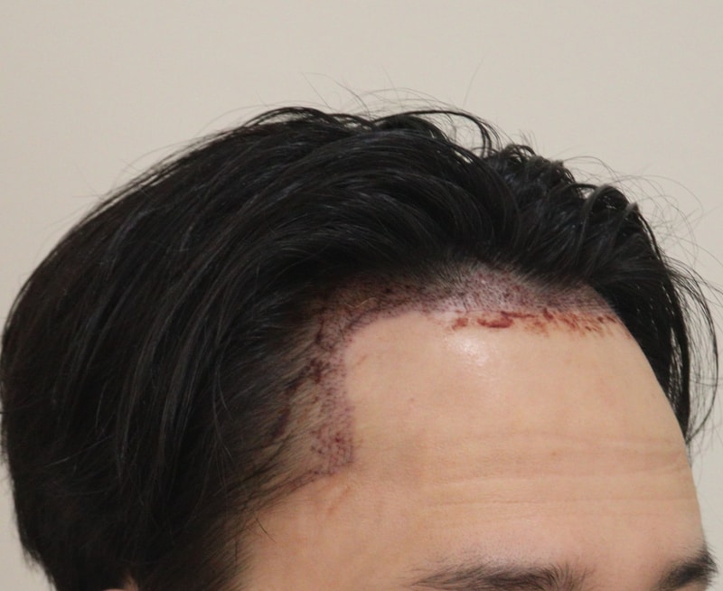 2. 수술후_1일_3.JPG