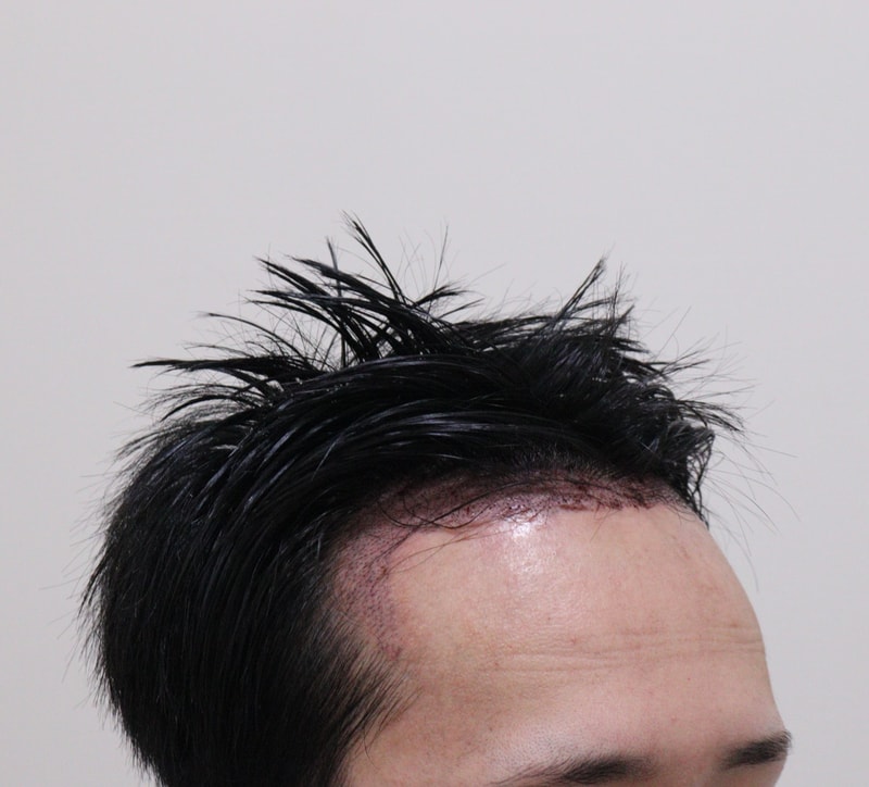 2. 수술후_1일_2.JPG