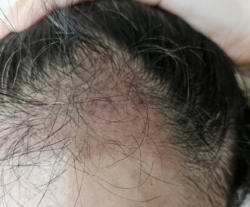 3. 수술후_3개월_셀카_2.jpg