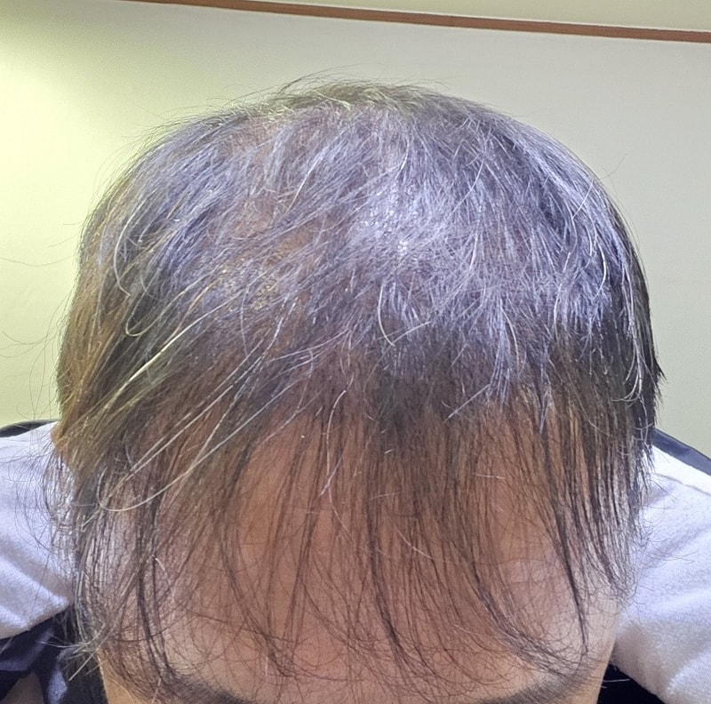 3. 수술후_3개월_셀카_1.jpg