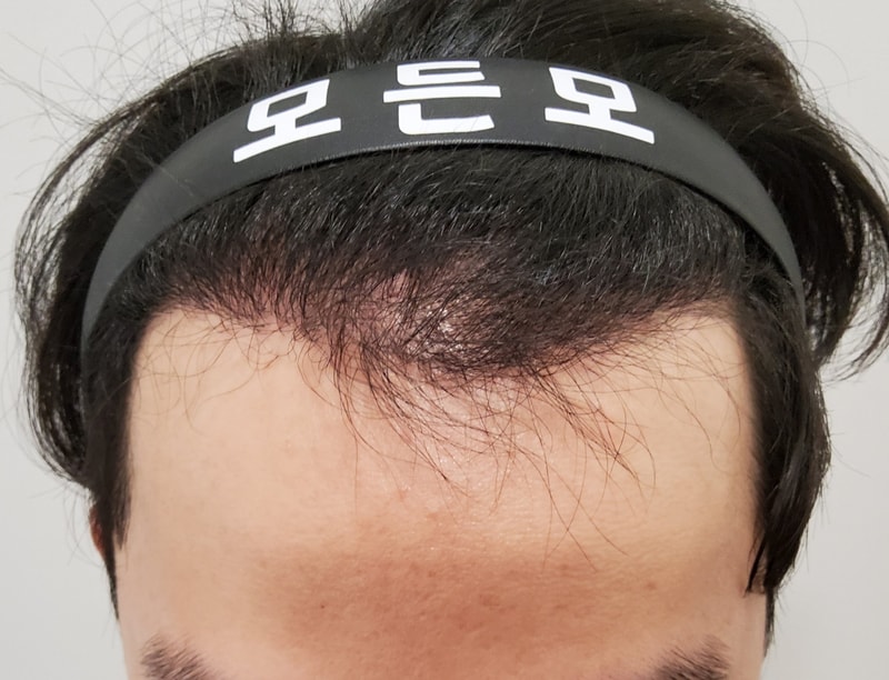 5. 수술후_6개월_1.jpg