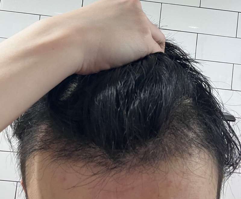 3. 수술후_3개월_셀카1.jpg