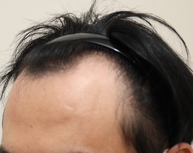 1. 수술전_2.JPG