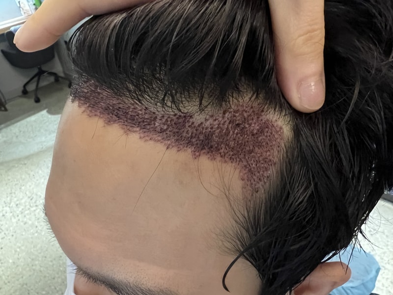 2. 수술후_1일_22.jpg