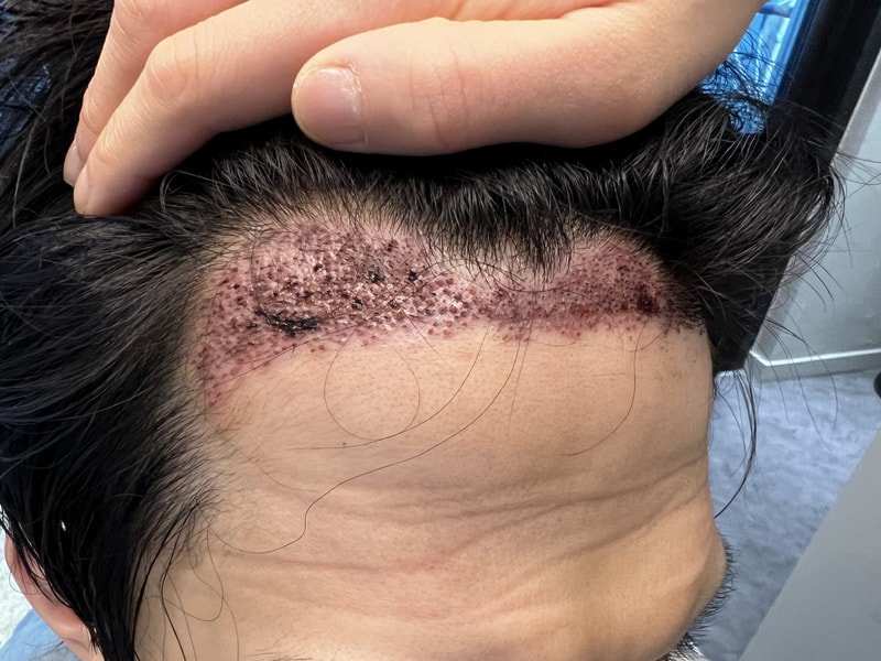 2. 수술후_1일_2.jpg